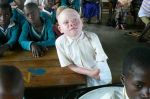 albinos-tanzania-12